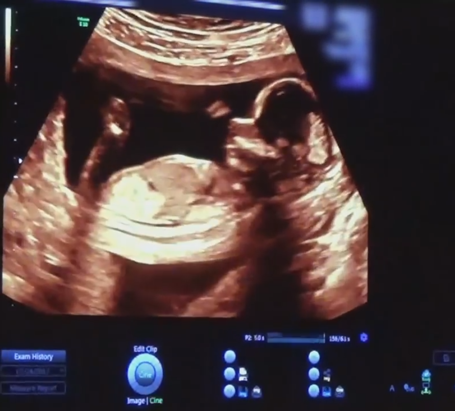 Kylie's actual ultrasound