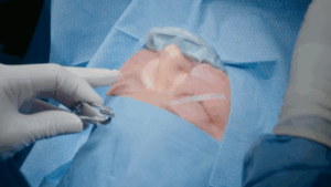 Amy Slaton undergoes eye surgery.