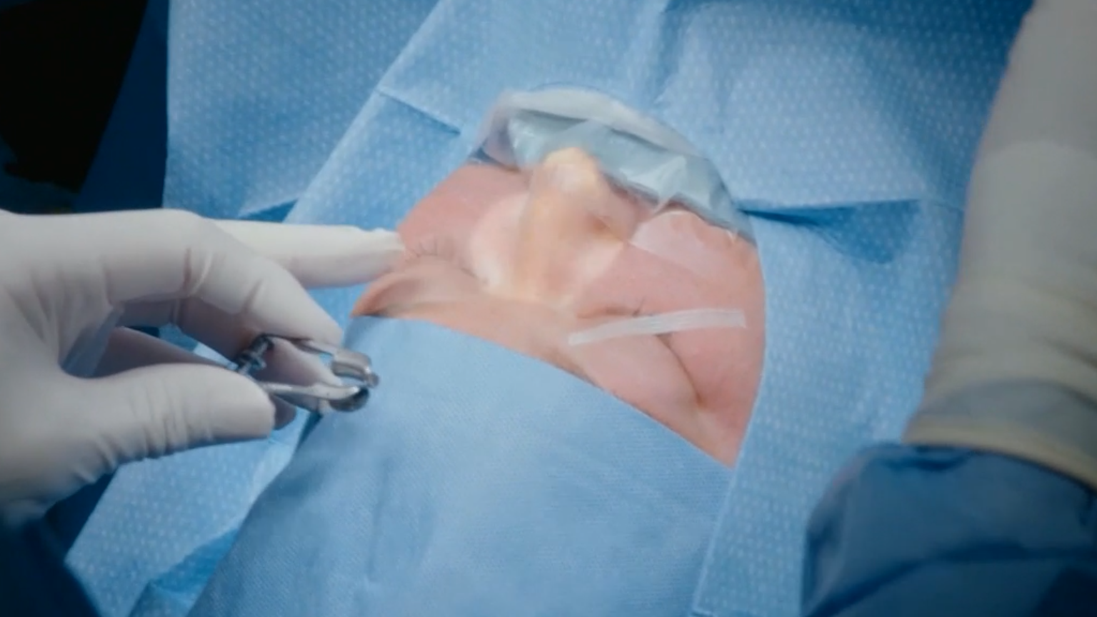 Amy Slaton Undergoes Long-Needed Eye Surgery