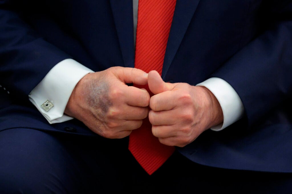 A bruise is visible on the back of U.S. President Donald Trump's right hand during a meeting with South Korean President Lee Jae-myung in the Oval Office at the White House on August 25, 2025 in Washington, DC.
